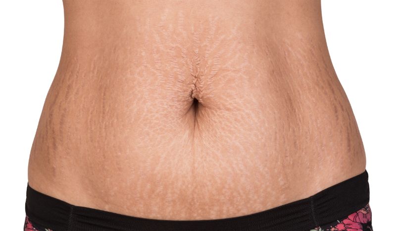 Eliza Facialist Stretch Mark Removal Facials Skin Care Laser Hair Removal Make Up Skin Clinic Skin Salon Beauty Salon Southampton Hampshire Uk